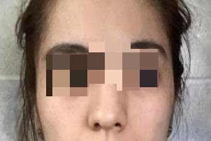 做自体软骨隆鼻手术让我的鼻子更加精致漂亮
