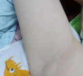 微整形攻略为什么突然就有腋臭了