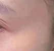 脂肪攻略自体脂肪除皱的好处有哪些