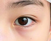 双眼皮手术价格受哪些因素影响？一文理清关