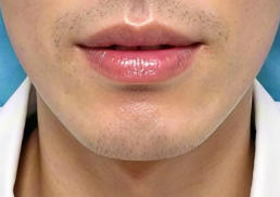 下颌角整形后多久能化妆？术后护理全攻略：