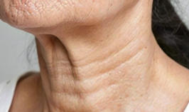 颈部皱纹显老态？这些除皱方法让你重返年轻态！