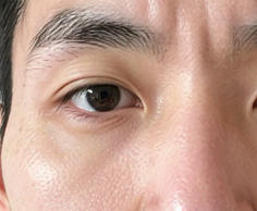 脂肪填充全解析：自然塑美，解锁青春饱满新魅力！