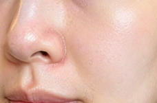 面部凹陷女的“焕颜”奇迹：从疲惫到饱满