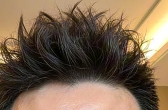 告别“秃”然危机，重拾浓密自信