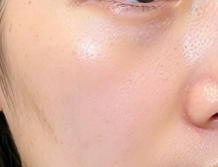 玻尿酸填充：解锁年轻态的秘密武器，你真的了解吗