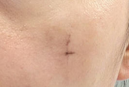 疤痕修复全指南：祛疤手术怎么选