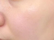 脂肪填充避坑指南：自体脂肪变废为宝，这两大疑问你一定要知道