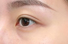 双眼皮手术全解析：自然美眼如何打造