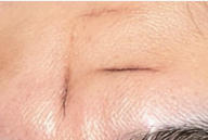 告别疤痕困扰：现代医学如何让你重获光滑肌