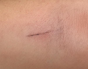 与疤痕“告别”：我的修复重生之旅