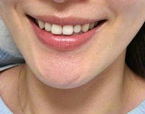 从“方脸困扰”到“V脸女神”：我的下颌角手术真实体验