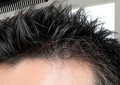 告别“秃”然焦虑，重拾浓密自信