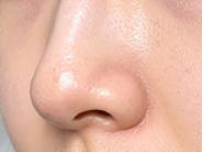 告别塌鼻遗憾，开启颜值新篇