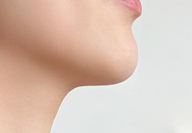 我的精致蜕变：下颌角手术开启新人生