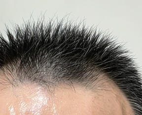 植发重生：我与稀疏发量的告别之战