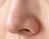 隆鼻蜕变：从塌鼻到精致鼻的美丽逆袭