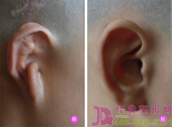 什么是蝶形耳廓及治療