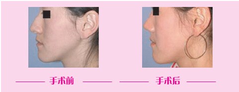 鼻翼縮小對(duì)比圖