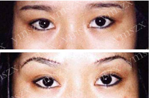 韓式提眉前后對比圖