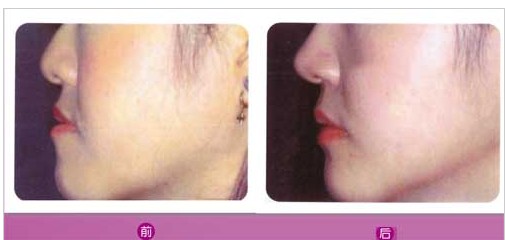 下顎前突修復(fù)對(duì)比圖
