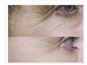 顳部除皺對(duì)比圖