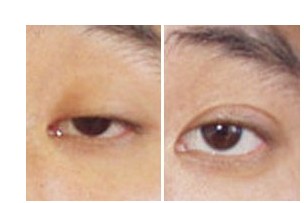 上瞼下垂矯正對比圖
