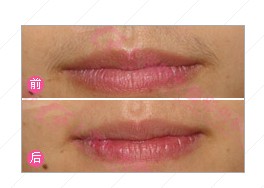 脫唇毛前后對(duì)比圖