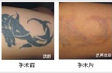 洗紋身前后對比圖