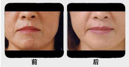 唇珠成形對(duì)比圖