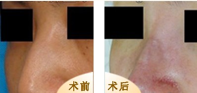 鷹鉤鼻整形對比圖