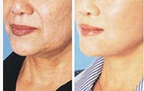 微創(chuàng)除皺對(duì)比圖