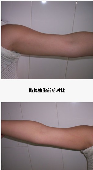 胳膊抽脂前后对比图