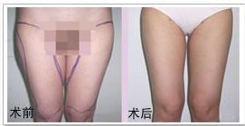 大腿吸脂前后對比圖