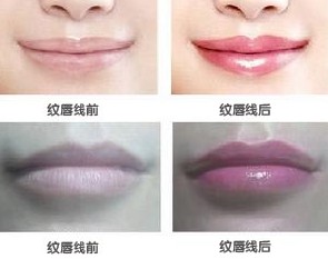 紋唇線前后對比圖