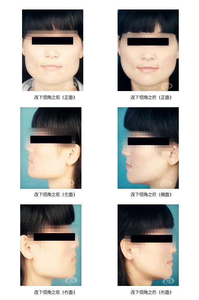 改脸型前后对比图