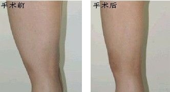吸脂瘦身前后对比图