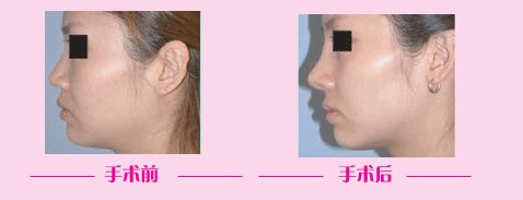 �nʽ¡�����g(sh��)ǰ�󌦱ȈD