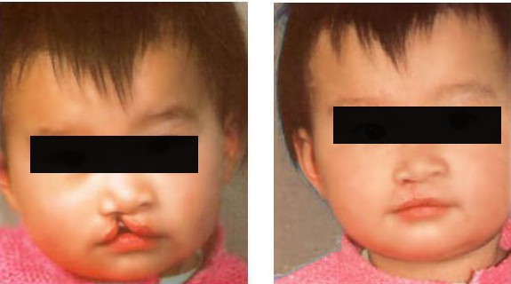 唇裂修復(fù)術(shù)對比圖