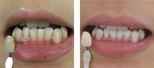 冷光美白牙齒前后對(duì)比圖