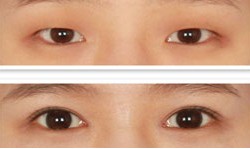 �nʽ΢��(chu��ng)�p��Ƥ���gǰ�󌦱ȈD