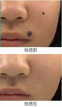 激光去痣成功案例