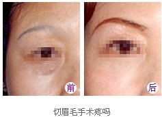 切眉手術(shù)成功案例