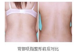 背部吸脂成功案例