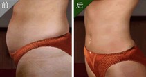 腰腹部吸脂手術(shù)成功案例