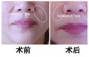 鼻唇溝填充修復(fù)手術(shù)效果圖