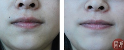 激光去痣治療后如何護理