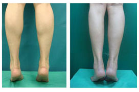 瘦腿針手術(shù)效果圖