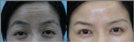 激光去抬頭紋手術(shù)效果圖