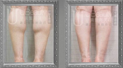 BOTOX注射瘦小腿手術(shù)效果圖